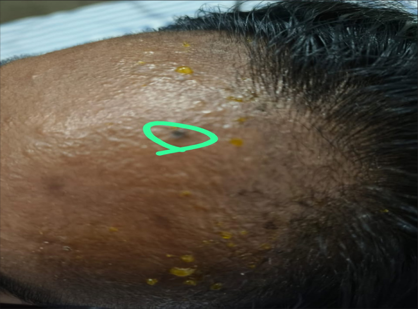 Eccrine chromhidrosis with bilirubin in sweat on the forehead (green circle)