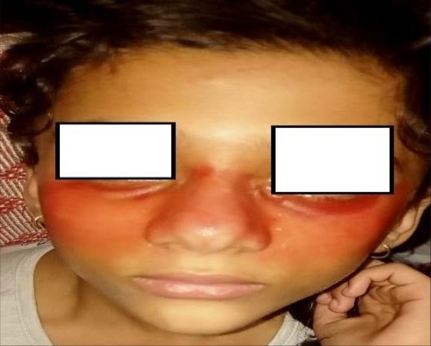 A 12-year-old girl with pseudo-chromhidrosis after cycling.