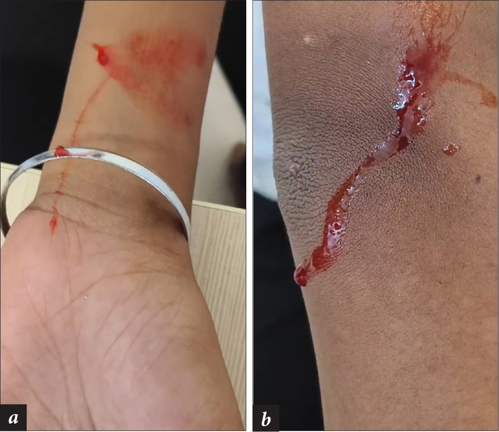 Haematidrosis in the same patient on two different areas of the body at the same time.