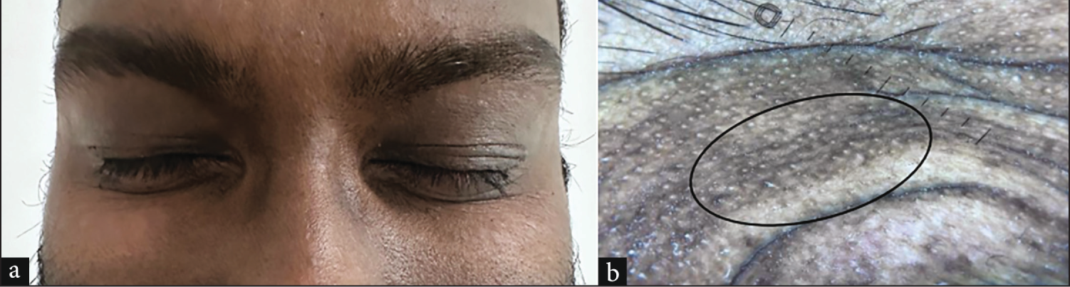 (a) 25-year-old male with periorbital hypermelanosis, (b) Dermoscopy shows an epidermal and dermal cobblestone pattern with exaggerated skin markings (oval circle) (combinations of both polarised and non-polarised, 50x).