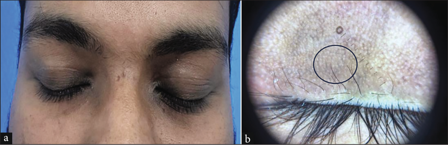 (a) 19-year-old male with periorbital hypermelanosis, (b) Dermoscopy shows epidermal pigmentation with cobblestone-type brown macules with central hypopigmentation showing melanin in the epidermis around the infundibula (black circle - combinations of both polarised and non-polarised, 20x).