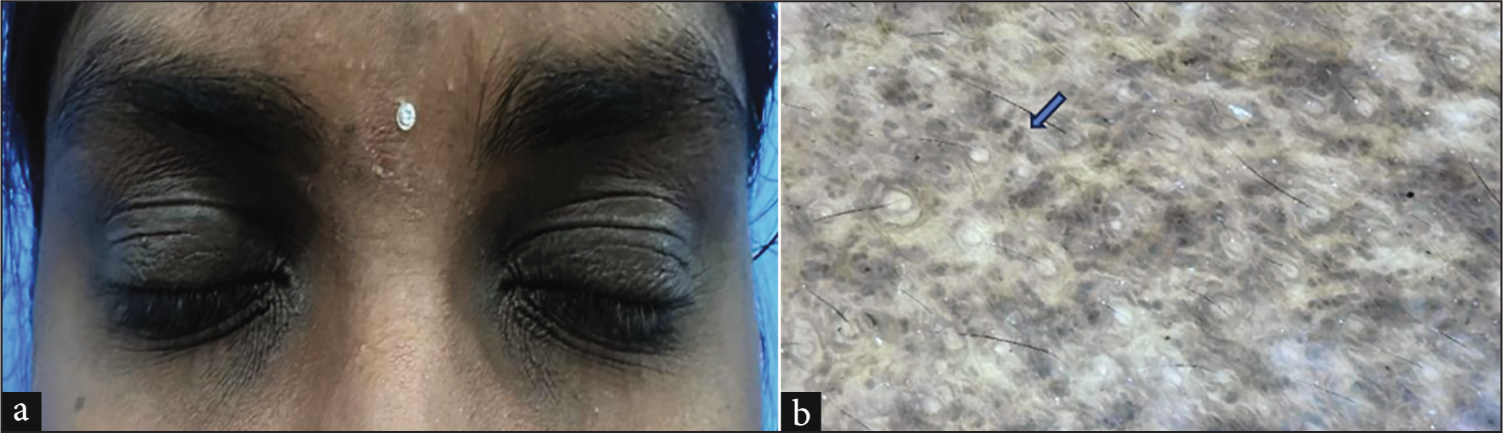 (a) 27-year-old woman with periorbital hypermelanosis, (b) Dermoscopy shows globular blotchy dermal pigmentation (blue arrow - combinations of both polarised and non-polarised, 100x).