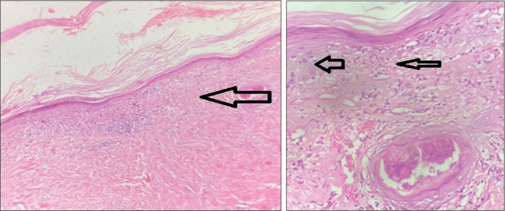 Histopathological image showing necrotic keratinocytes high up in the epidermis (black arrows) together with dense band-like lymphocytic infiltrate hugging the dermo-epidermal junction (a & b Haematoxylin and eosin (a) 10x (b) 40x).